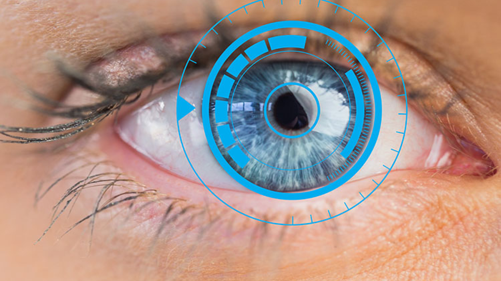 Corneal rings implantation