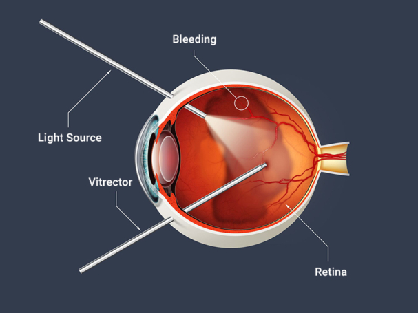 جراحات الشبكية والجسم الزجاجي (retina & vitreous surgery)
