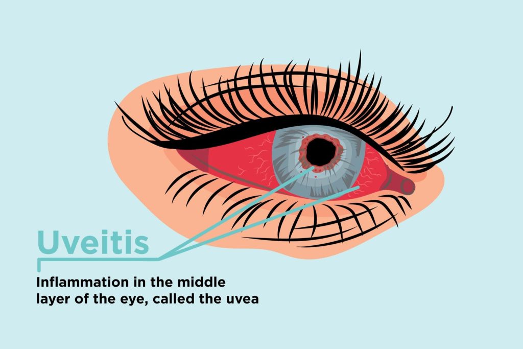 What is uveitis?