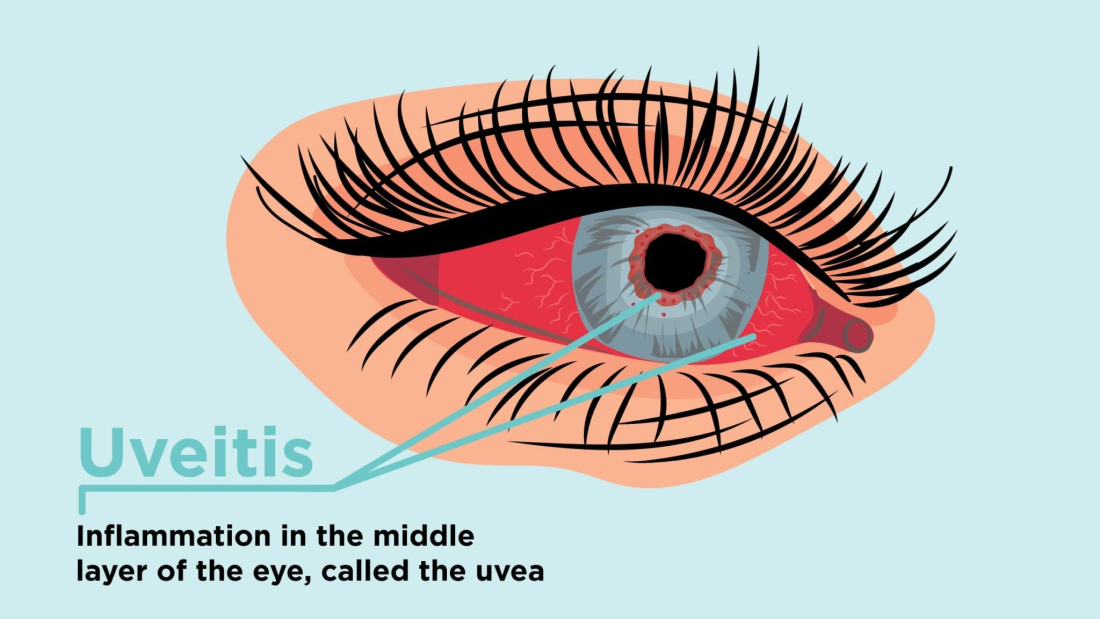1018_Uveitis