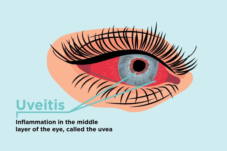 What is uveitis?