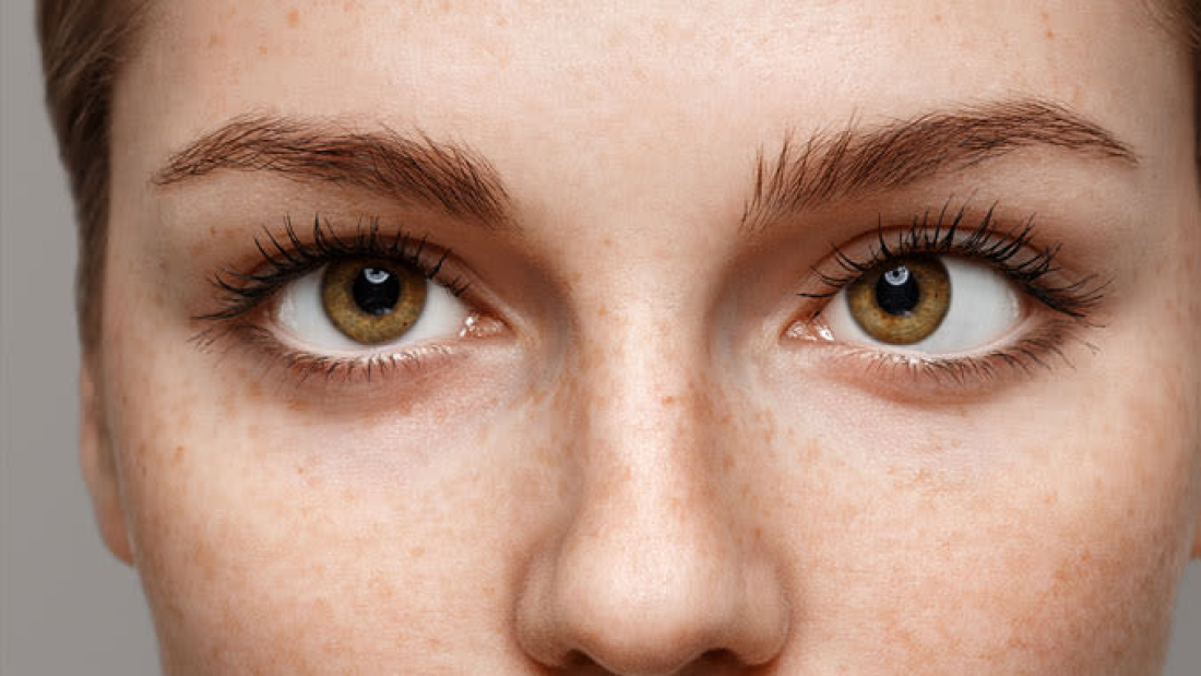 Strabismus-678x446