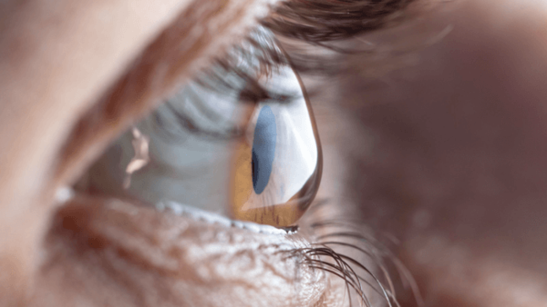 keratoconus