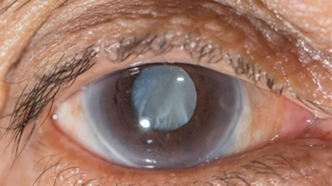 Cataract-Surgery