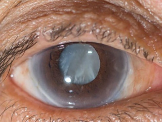 Cataract-Surgery