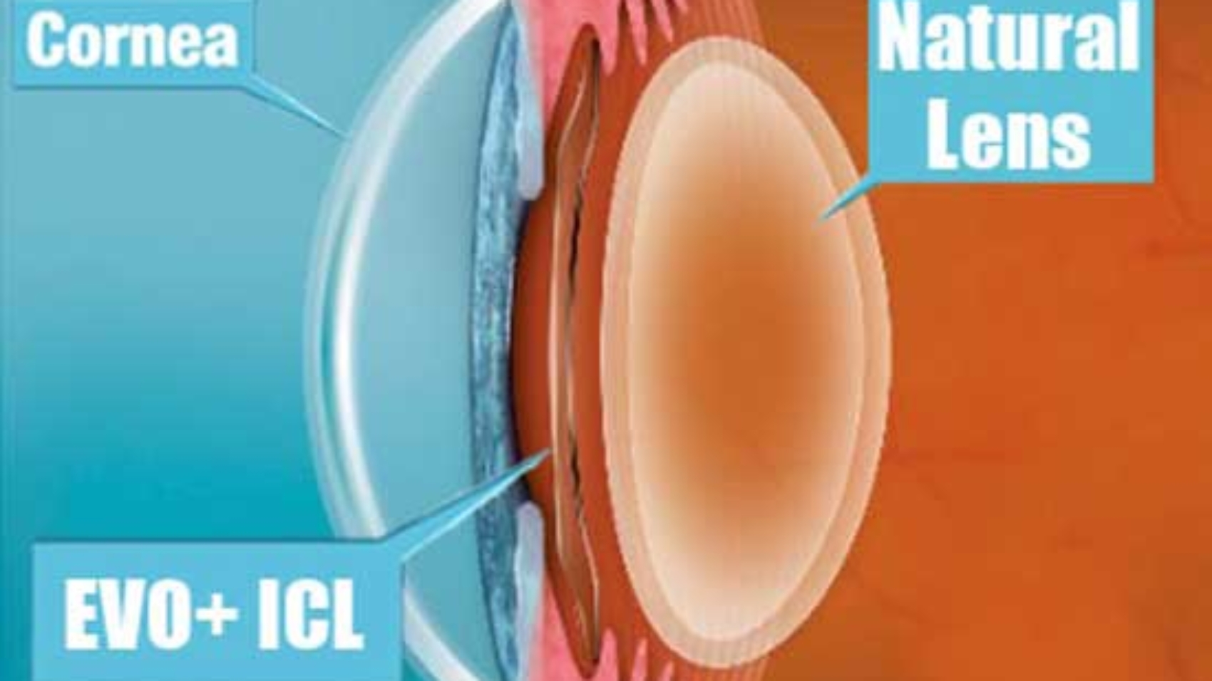 EVO-Visian-ICL-implanted-cross-section-position-2-feb-19