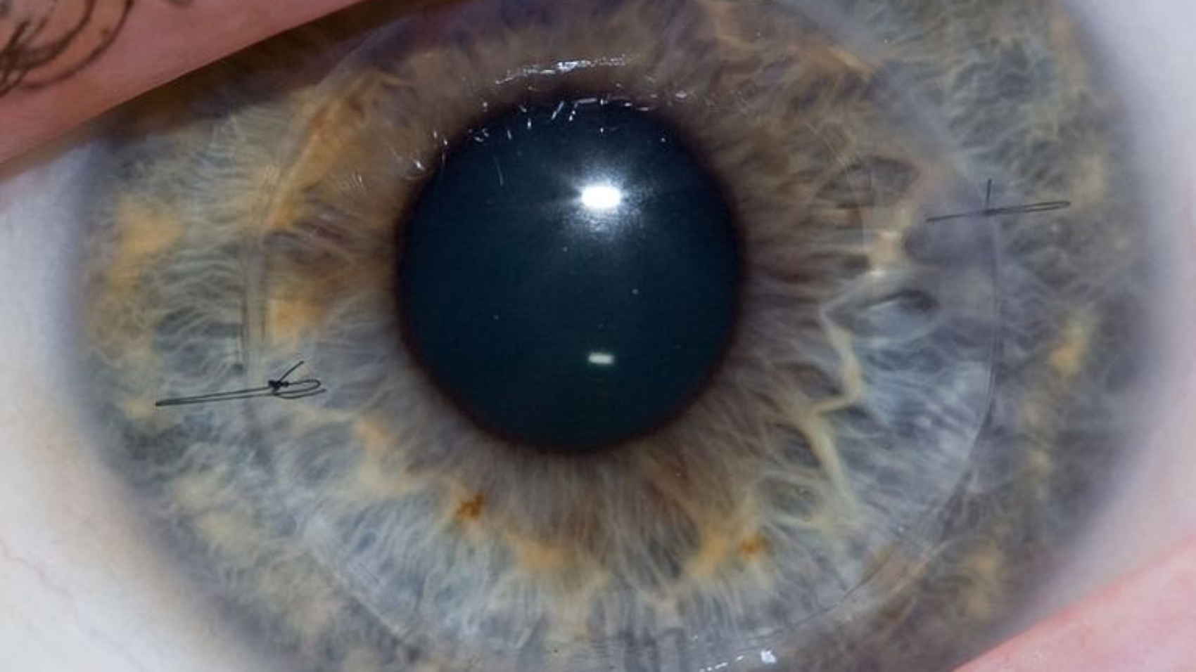 76-115850-corneal-transplantation-eye-ulcer-2