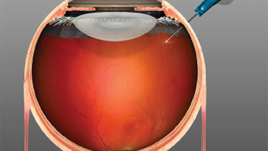 intravitreal-inj-intro-image
