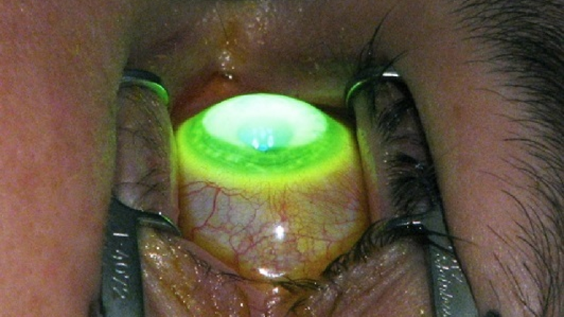 Cost of Keratoconus Surgery