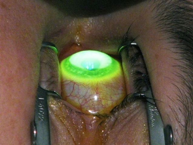 Cost of Keratoconus Surgery