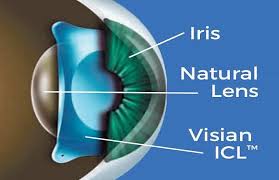 زراعة عدسات ال ICL