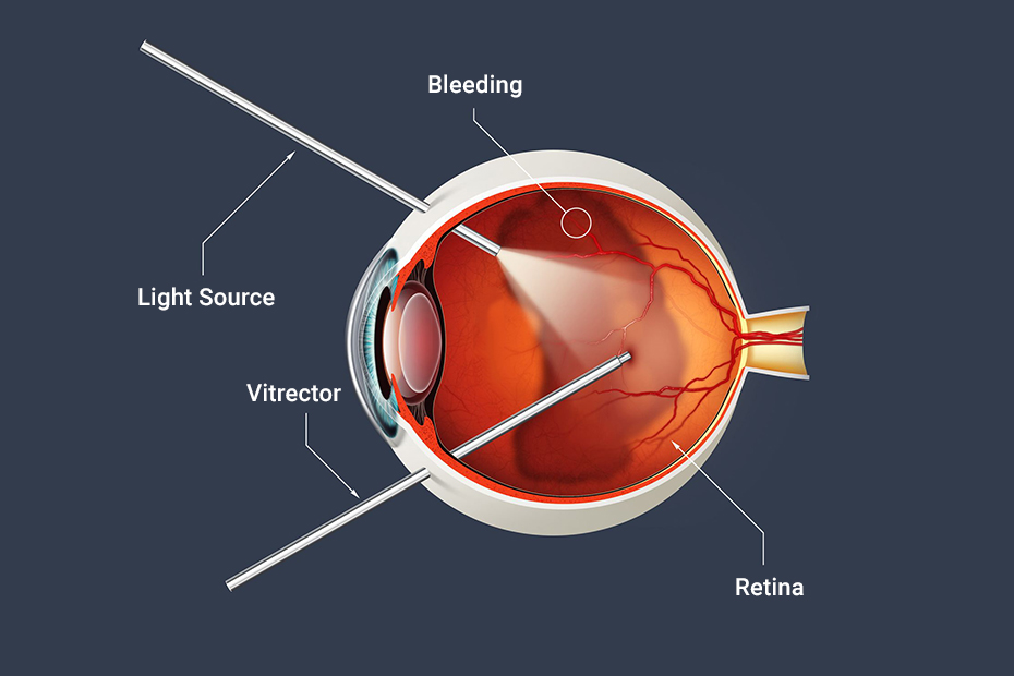 جراحات الشبكية والجسم الزجاجي (retina & vitreous surgery)