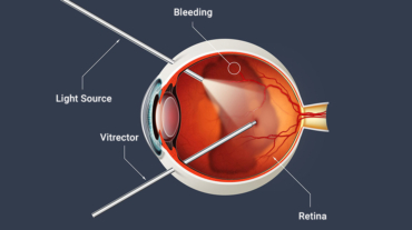 جراحات الشبكية والجسم الزجاجي (Retina & Vitreous Surgery)