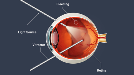 جراحات الشبكية والجسم الزجاجي (Retina & Vitreous Surgery)