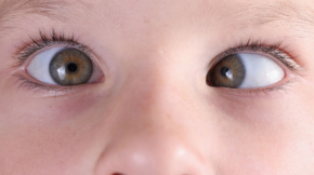 Children Problems & Squint
