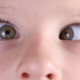 Children Problems & Squint